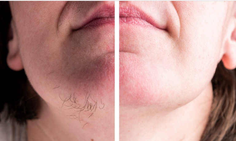 Austria: Zakład ubezpieczeń zdrowotnych musi zapłacić za depilację transpłciowej kobiety