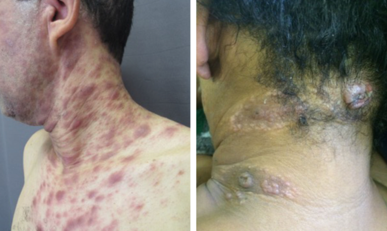 Alarmujący rekordowy wzrost zakażeń syfilisem w Niemczech – Berlin na czołowej pozycji