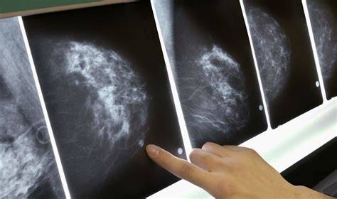 Szwajcaria jako pierwszy kraj zakazuje mammografii